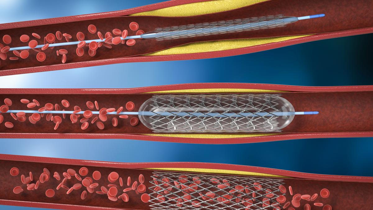Chief Minister’s Angioplasty Comments Prompt Call for Evidence‑Based Guidance